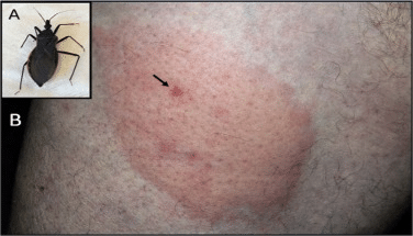 Identify Kissing Bug Bites