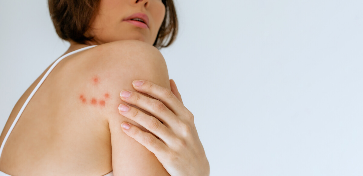 Woman with several bed bug bites on her shoulder