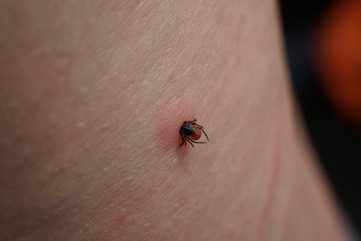 Tick Bites