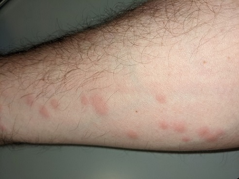 Mosquito Bites