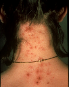 Lice Bites