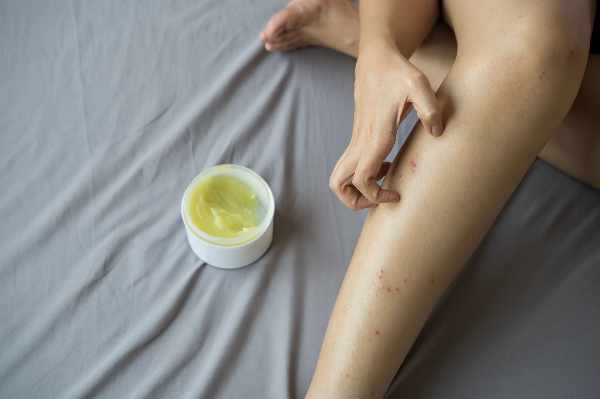 Woman applying mosquito bite relief ointment